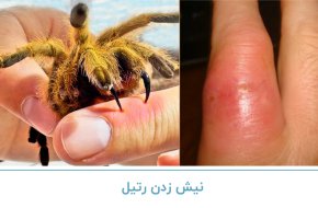 نیش زدن رتیل